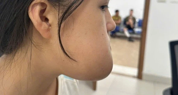 Phẫu thuật loại bỏ khối u, lấy lại thẩm mỹ khuôn mặt cho cô gái 16 tuổi