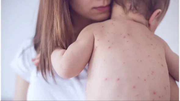 Cảnh báo các dịch bệnh nổi lên trong mùa hè 2025