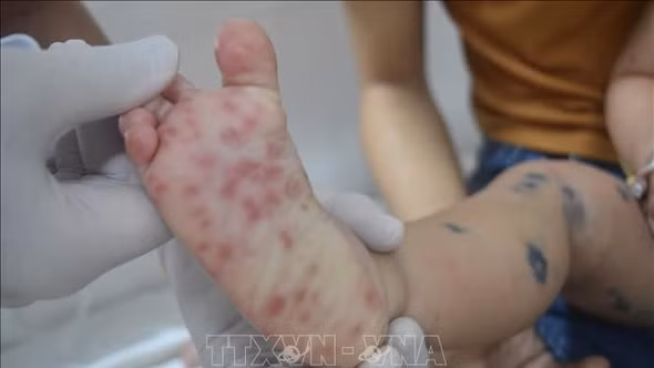 Tăng cường công tác truyền thông, kiểm soát bệnh tay chân miệng