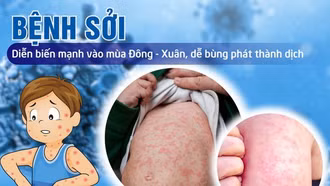 Thủ tướng yêu cầu tăng cường công tác phòng, chống bệnh sởi
