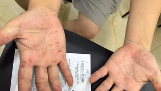 Số ca tay chân miệng tăng mạnh, cảnh báo nguồn lây từ tay nắm cửa, đồ chơi