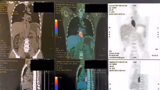 Nuốt nghẹn, sụt 5 kg, đi khám phát hiện mắc hai loại ung thư