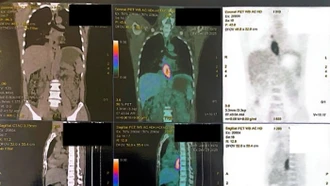 Nuốt nghẹn, sụt 5 kg, đi khám phát hiện mắc hai loại ung thư