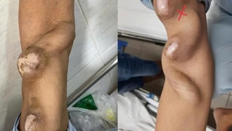 Cảnh báo suy thận ở người trẻ