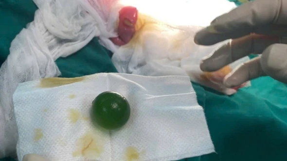 Cấp cứu thành công bệnh nhi 13 tháng tuổi bị tắc ruột do nuốt phải hạt nở