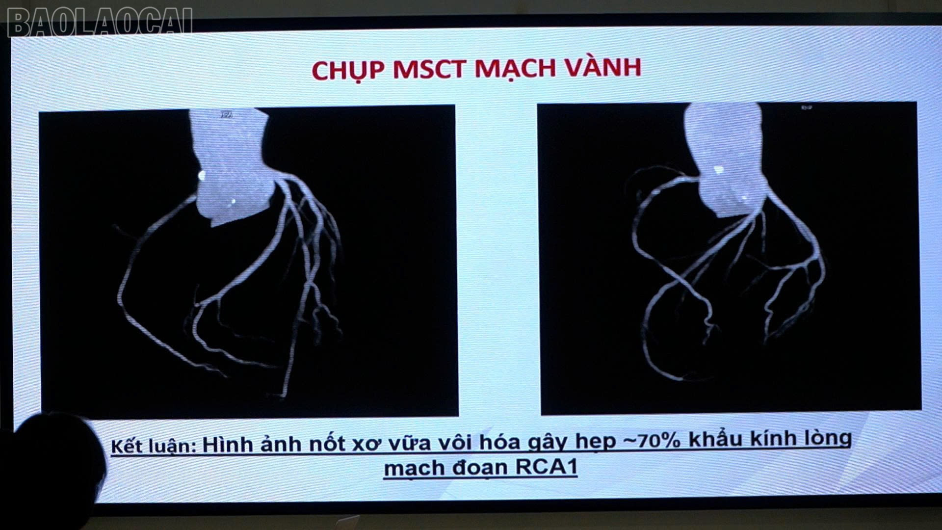 BSCKII. Trần Hồng Chuyên - PGĐ Trung tâm Tim mạch - Bệnh viện Đa khoa số 2 tỉnh Lào Cai phân tích tình huống trên các ca lâm sàng hội chứng mạch vành mạn. baolaocai-tl_z6910249382164-4d37de0bbdcc9cf6c17afbc419b5295a.jpg
