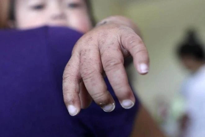 Lần đầu tiên sau 5 năm số ca nhiễm sởi ở Mỹ vượt ngưỡng 1.000.