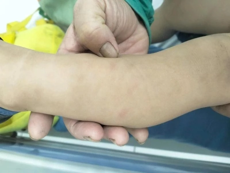 Các vết bầm trên cánh tay của trẻ