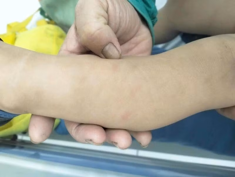 Các vết bầm trên cánh tay của trẻ