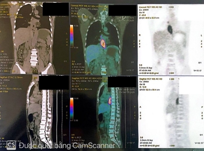 Hình ảnh PET/CT dày thành thực quản ⅓ dưới thâm nhiễm mỡ, chưa xâm lấn động mạch chủ ngực, tăng chuyển hoá FDG.