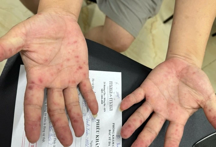 Nốt ban ở tay chân của bệnh nhân mắc tay chân miệng.