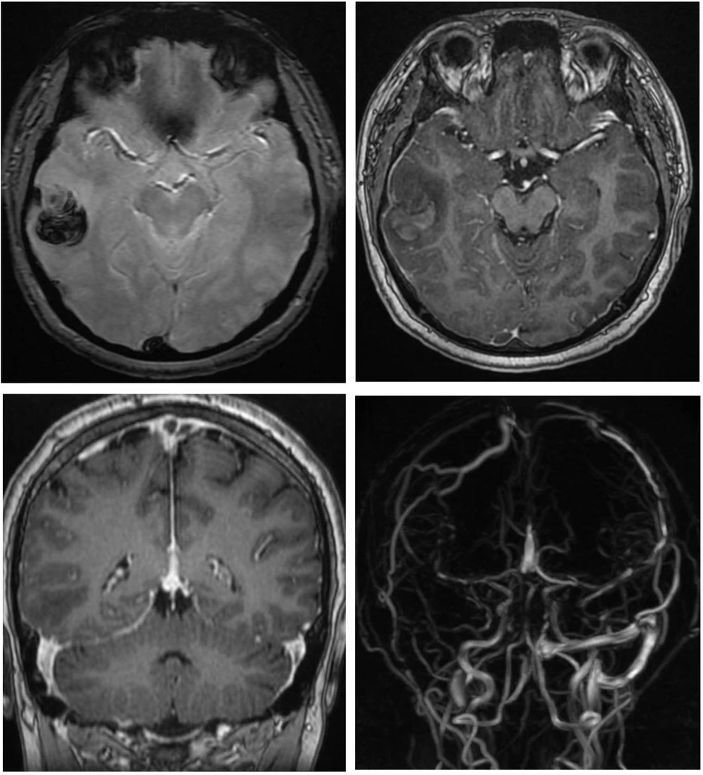 Chẩn đoán hình ảnh ghi nhận bệnh nhân xuất huyết não, huyết khối nhiều vị trí trong tĩnh mạch não.