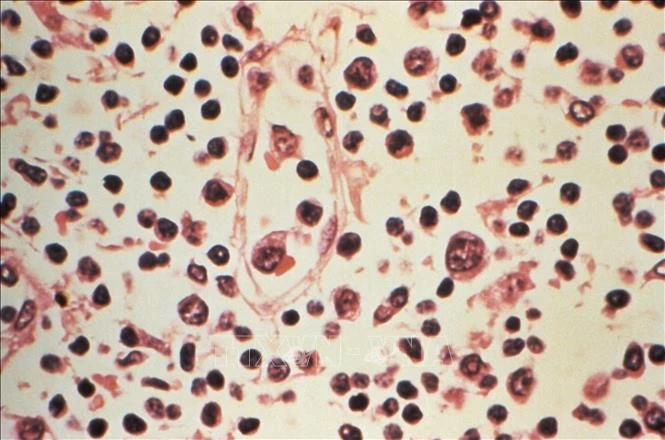 Mẫu bệnh phẩm của một bệnh nhân nhiễm virus Hanta.