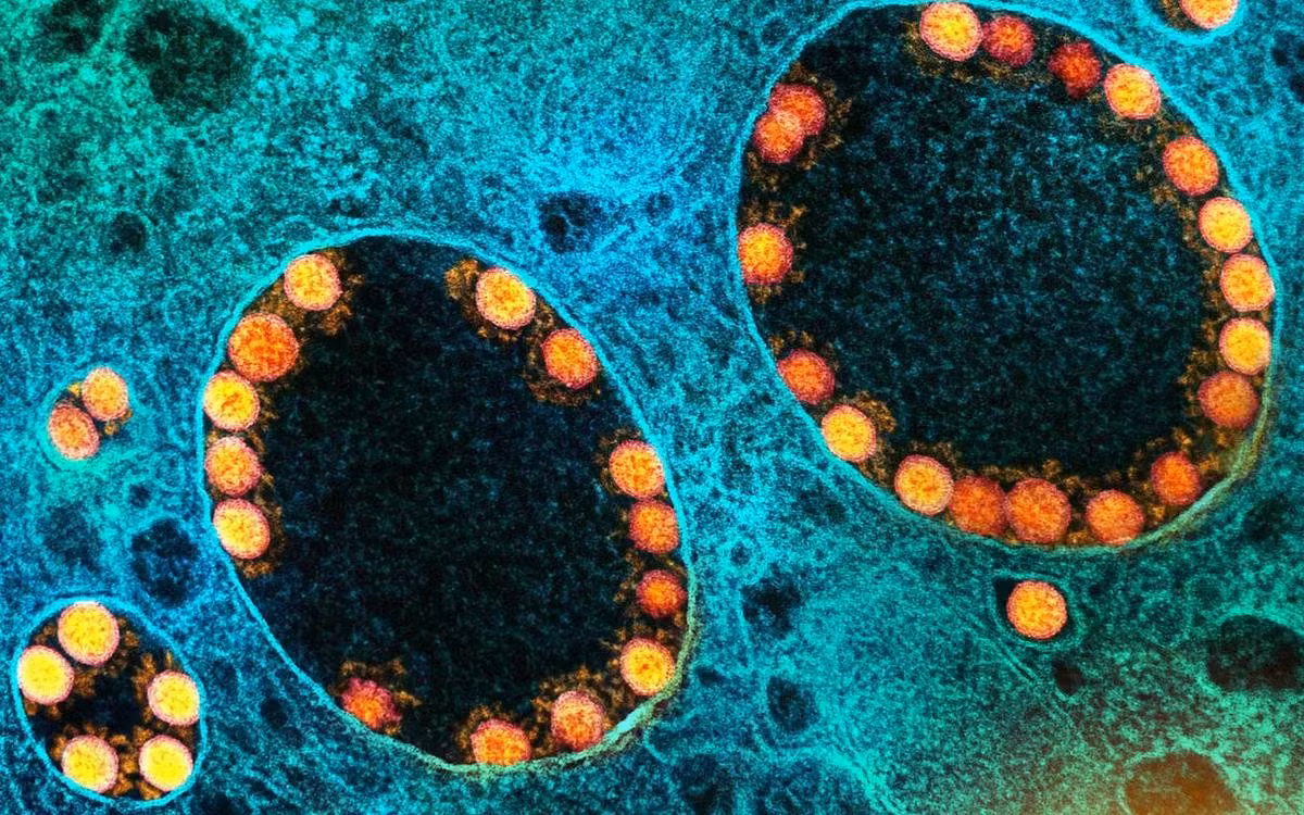 Do virus gây COVID-19 (màu vàng) và các loại virus RNA khác xâm nhập vào tế bào thông qua thể nội bào (endosome), nên các tạp chất trong vaccine mRNA có thể kích hoạt những phản ứng miễn dịch tương tự.
