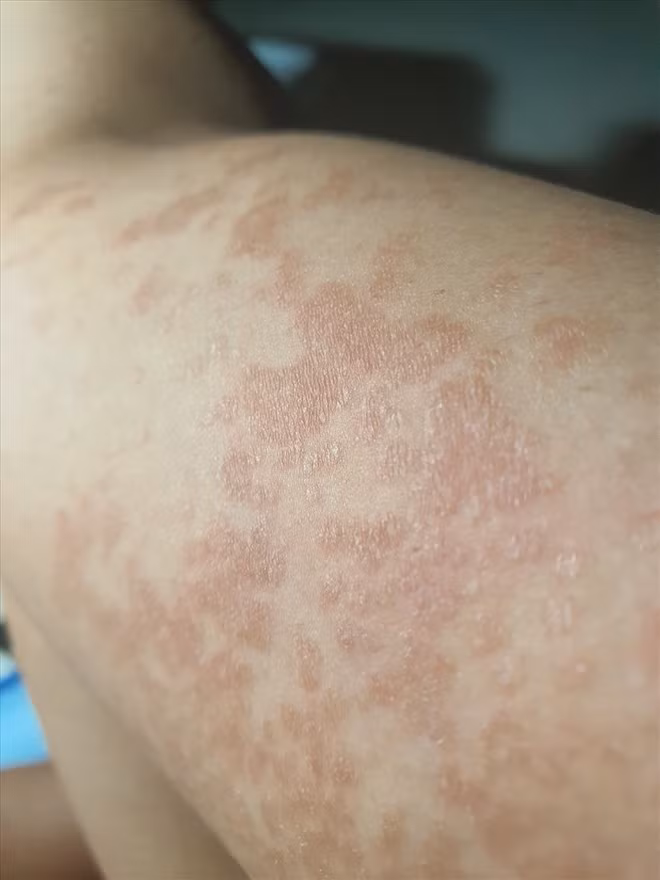 Nhiều bệnh về da hiếm gặp cần nghiên cứu tìm ra hướng điều trị.