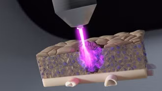Tia plasma lạnh tiêu diệt tế bào ung thư ẩn sâu