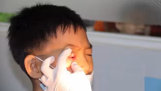 Ngành Y tế khuyến cáo chủ động phòng ngừa dịch bệnh do Adenovirus và đau mắt đỏ