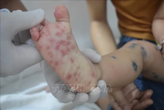 Bệnh tay chân miệng ở trẻ em.