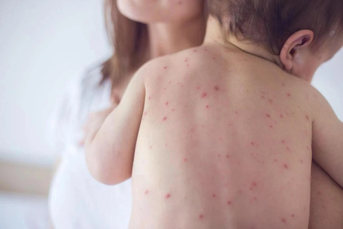 Nếu trong điều kiện không có biến chứng, các bậc phụ huynh có thể dễ dàng chăm sóc trẻ mắc sởi tại nhà.