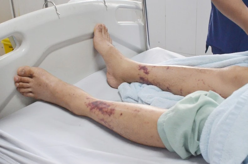 Vết xuất huyết dưới da rải rác sau 3 ngày nam bệnh nhân tại Hạ Long, Quảng Ninh mua và chế biến thịt lợn.