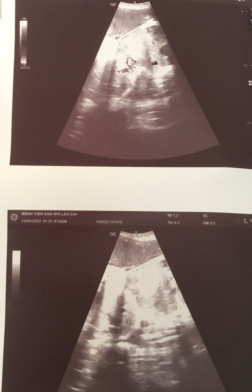 Bệnh viện Sản - Nhi tỉnh phẫu thuật thành công cặp song sinh dính bụng ảnh 1