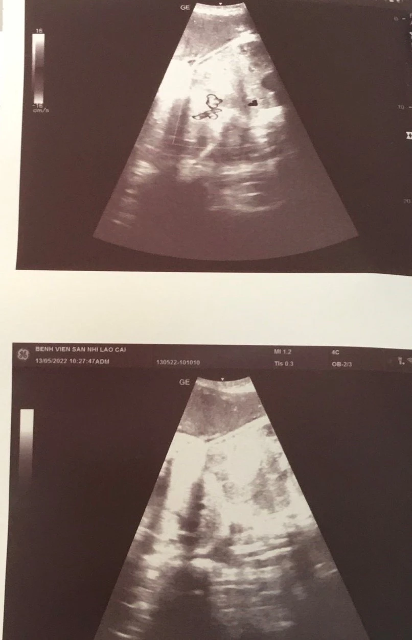 Bệnh viện Sản - Nhi tỉnh phẫu thuật thành công cặp song sinh dính bụng ảnh 1 Bệnh viện Sản - Nhi tỉnh phẫu thuật thành công cặp song sinh dính bụng ảnh 1