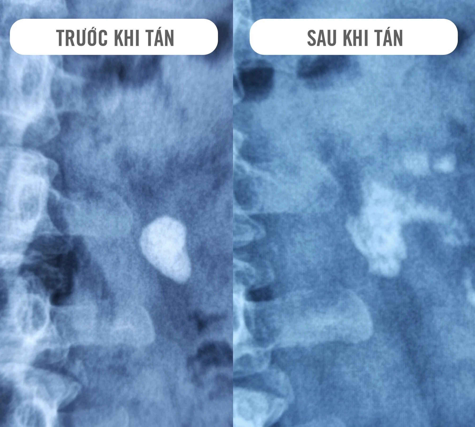 Bệnh viện Đa khoa Hưng Thịnh: Triển khai kỹ thuật tán sỏi ngoài cơ thể bằng sóng xung kích ảnh 2 Bệnh viện Đa khoa Hưng Thịnh: Triển khai kỹ thuật tán sỏi ngoài cơ thể bằng sóng xung kích ảnh 2