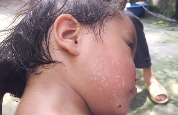 Má cháu bé ửng đỏ sau khi bôi thuốc. Má cháu bé ửng đỏ sau khi bôi thuốc.