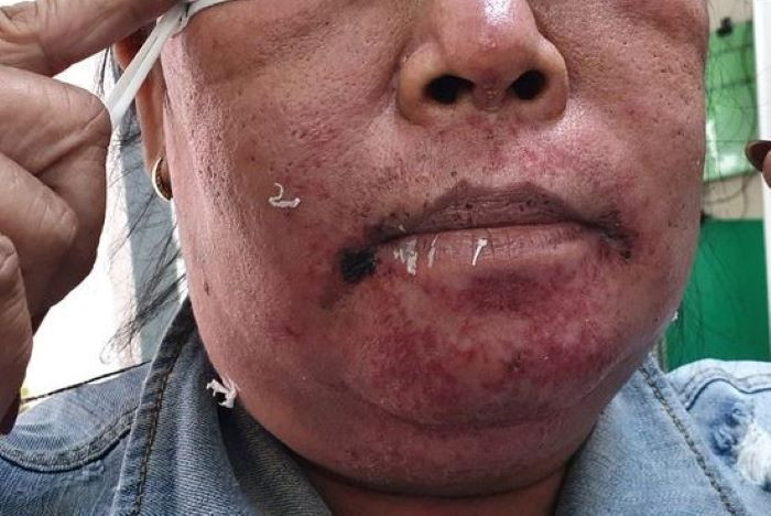 'Thuốc 7 màu' và những tác hại khi sử dụng không đúng cách ảnh 1 Dùng kem trộn và thuốc 7 màu khiến làn da sưng đỏ nứt nẻ.