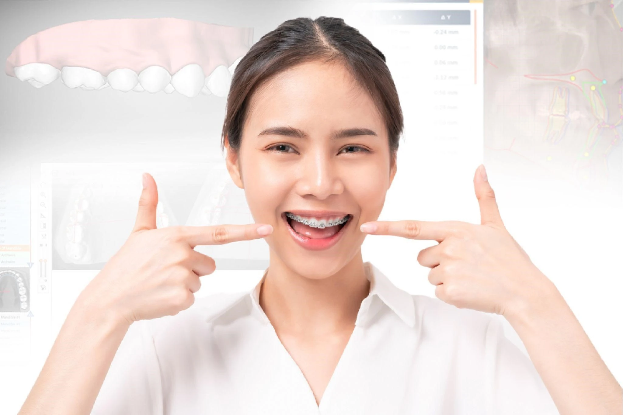 Niềng răng kim loại giúp kéo khoảng trống do mất răng cửa để lại