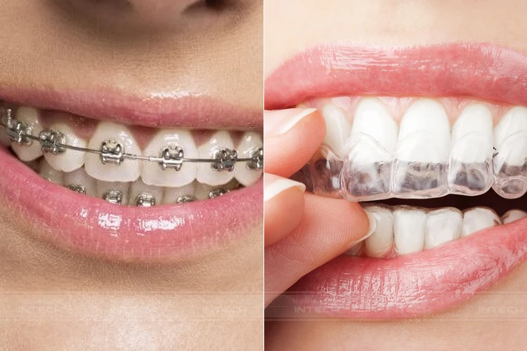 Niềng răng mắc cài và niềng răng khay trong suốt khi mất răng cửa