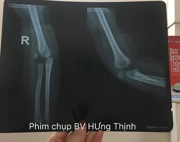 Hình ảnh phim chụp X - quang tại Bệnh viện Đa khoa Hưng Thịnh khá rõ vết tổn thương xương.