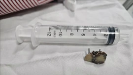 Nội soi lấy thành công 2 răng giả tồn tại trong phổi bệnh nhân hơn 20 năm