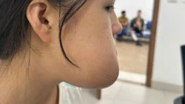 Phẫu thuật loại bỏ khối u, lấy lại thẩm mỹ khuôn mặt cho cô gái 16 tuổi