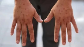 Anh ghi nhận ca đầu tiên nhiễm chủng mới của virus đậu mùa khỉ