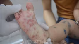 Tăng cường công tác truyền thông, kiểm soát bệnh tay chân miệng