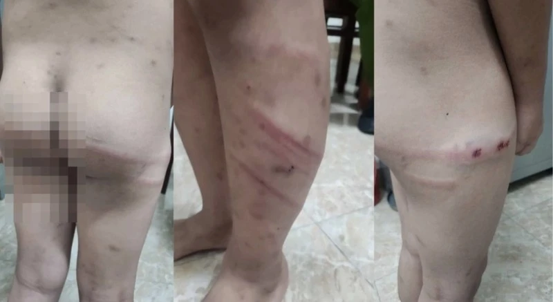 Hình ảnh cháu M. bị mẹ ruột và người tình của mẹ đánh đập gây thương tích nghiêm trọng.
