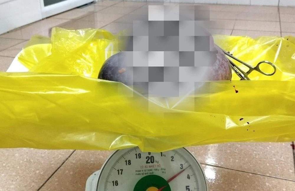 Khối u nang sau khi được lấy ra(1).jpg