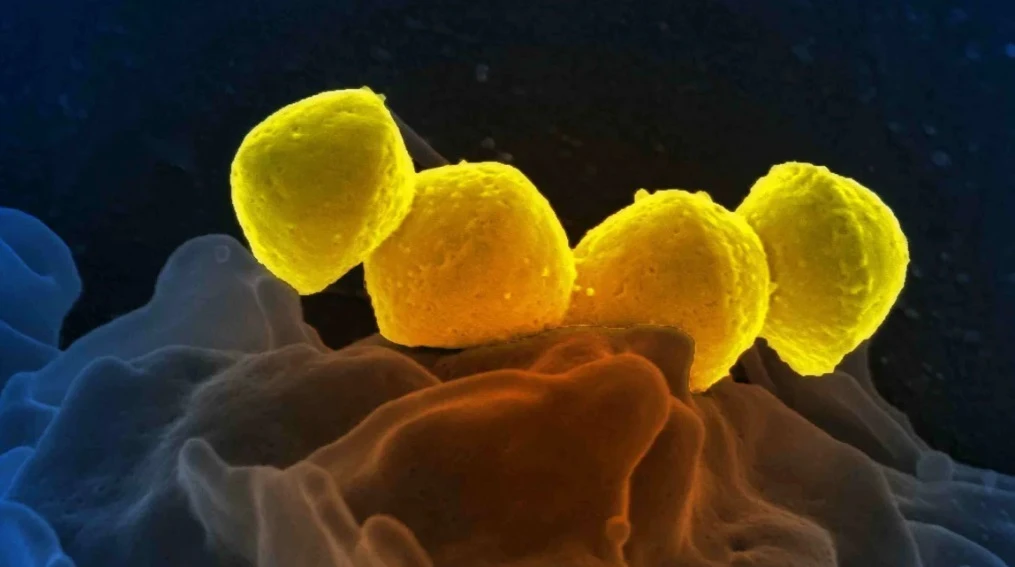 Ảnh minh họa vi khuẩn Streptococcus Nhóm A trên bạch cầu trung tính trong cơ thể người là một trong những nguyên nhân gây STSS.
