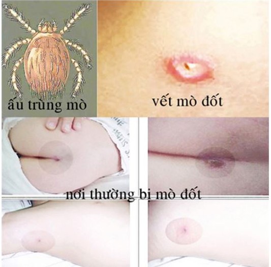 Người dân Yên Bái cần chú trọng các biện pháp phòng bệnh sốt mò ảnh 2