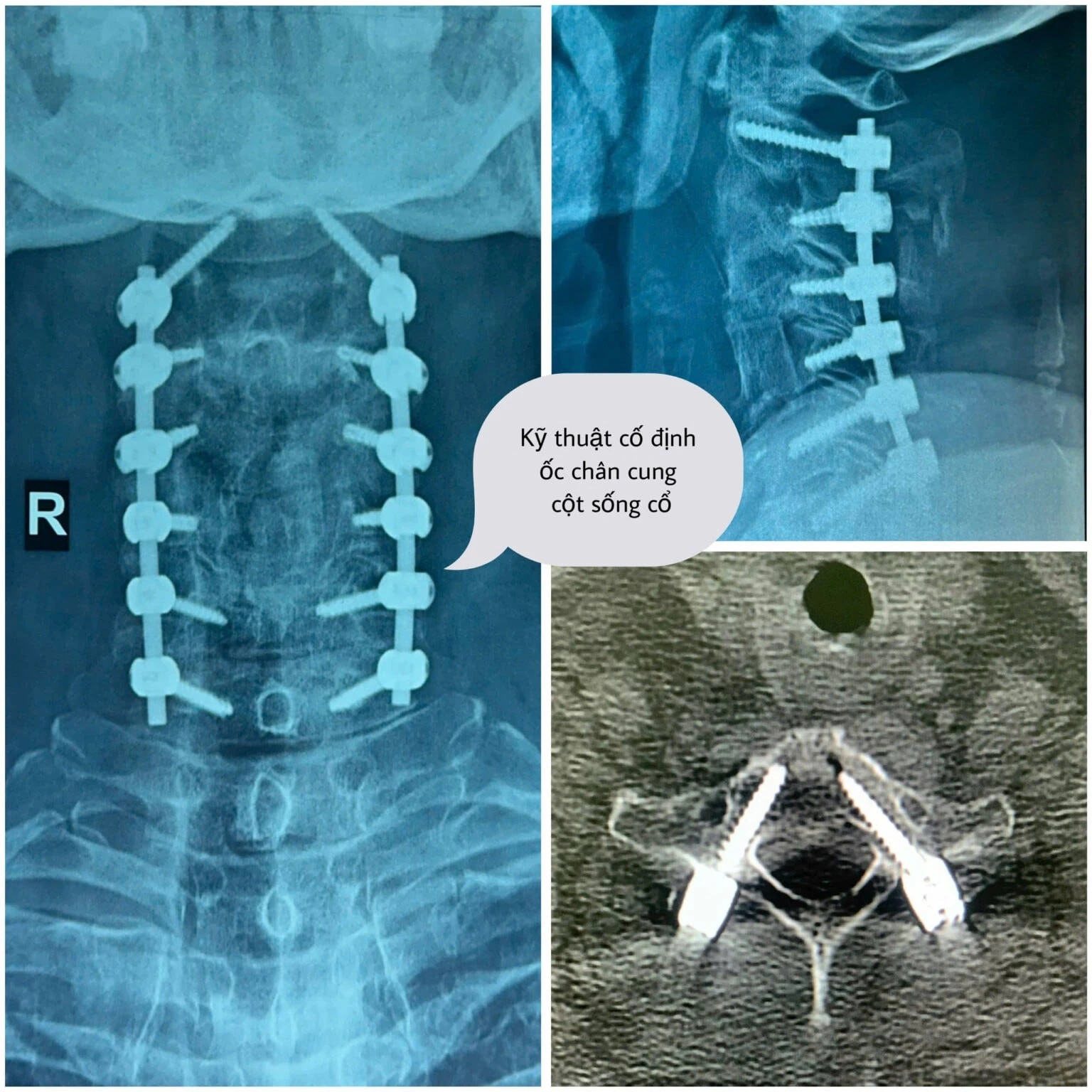 Phẫu thuật đặt ốc chân cung cột sống cổ.