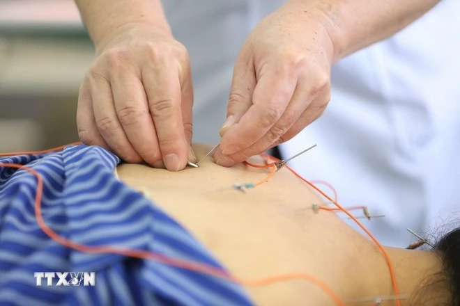 Sử dụng phương pháp Điện châm điều trị cho bệnh nhân tại Bệnh viện Y học cổ truyền tỉnh Lạng Sơn.