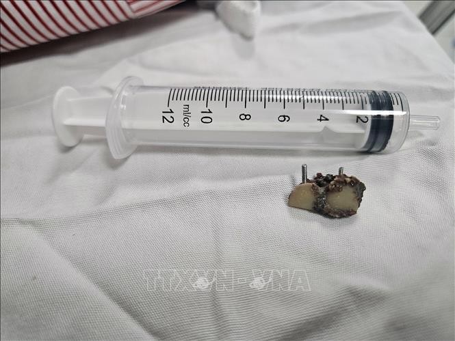 Dị vật là 2 chiếc răng giả được nội soi lấy ra khỏi phế quản bệnh nhân.
