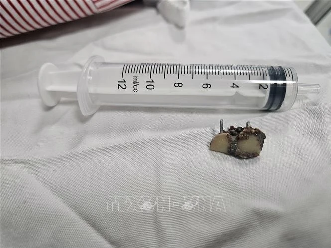 Dị vật là 2 chiếc răng giả được nội soi lấy ra khỏi phế quản bệnh nhân.