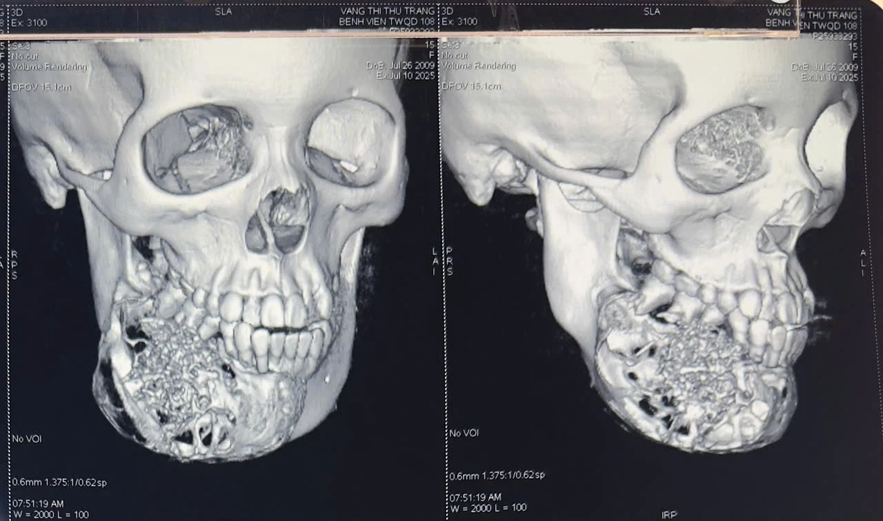 Hình ảnh khối u phát triển ở xương hàm dưới.