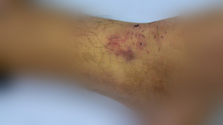 Vết thương do rắn lục đuôi đỏ cắn.