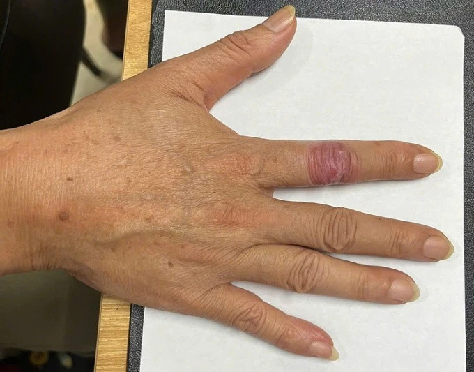 Tổn thương ở ngón tay hơn một năm không khỏi.