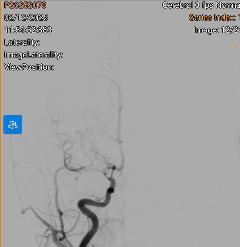 Đây là hình ảnh tắc mạch trước can thiệp.