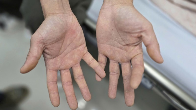 Bàn tay của anh H. bị tê bì, không thể khép lại và mất cảm giác. bong-cuoi.jpg