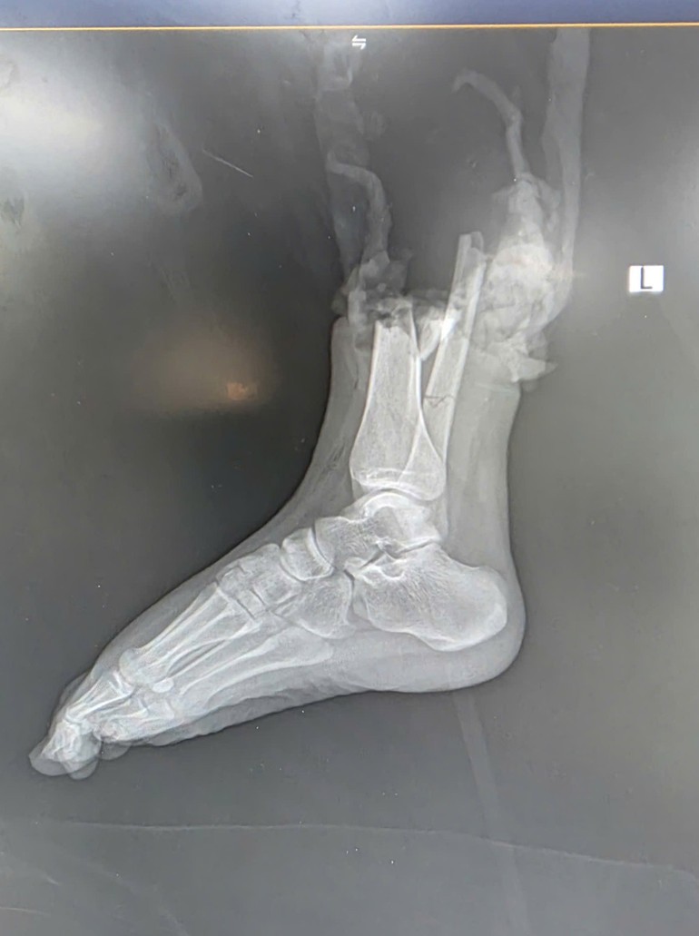 Hình ảnh tổn thương trên CT. Hình ảnh tổn thương trên CT.